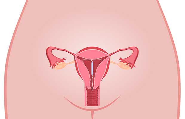 A vez do DIU? Saiba mais sobre o método contraceptivo do momento