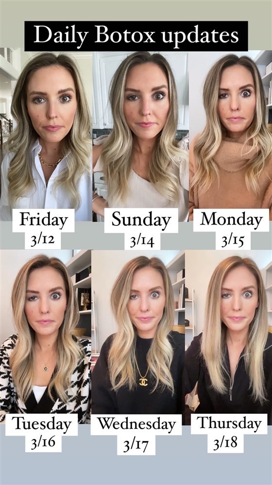 Influenciadora mostra botox que deu errado Influenciadora mostra botox que deu errado