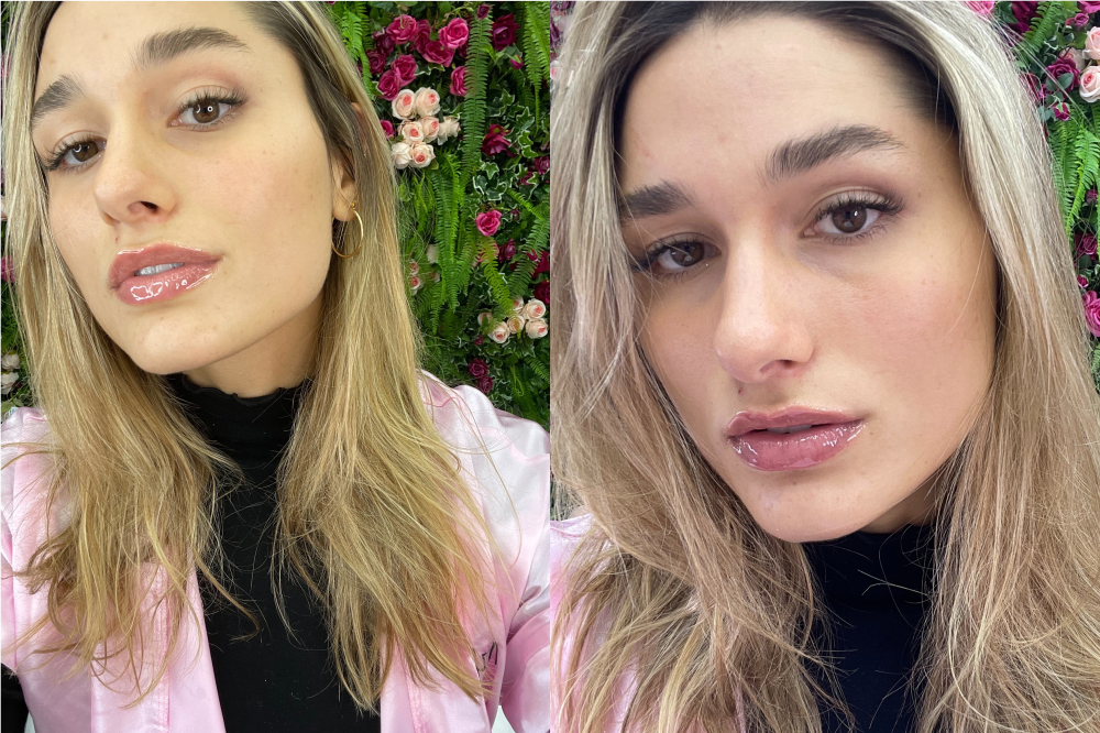 sasha-meneghel-procedimento-labios-volumosos Montagem com duas selfies da Sasha Meneghel após ter feito um procedimento para deixar os lábios mais volumosos. Ela está usando uma blusa preta, jaqueta rosa e com expressão facial séria.