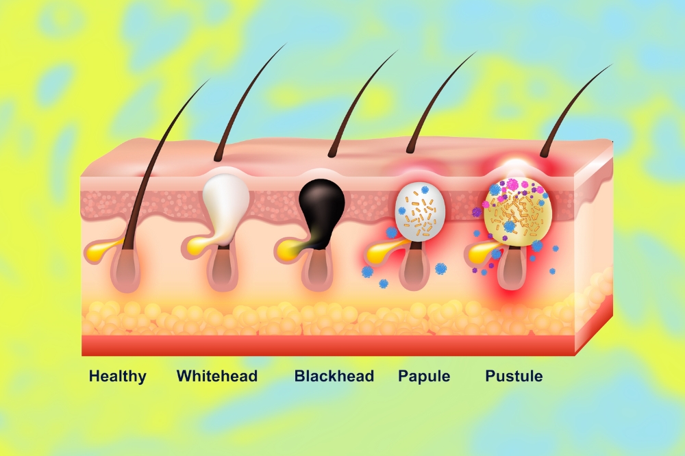 Tipos de acne