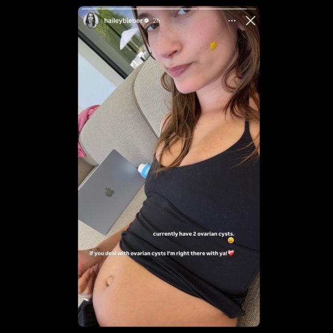 Hailey Bieber mostra abdômen inchado por conta de dois cistos no ovário.